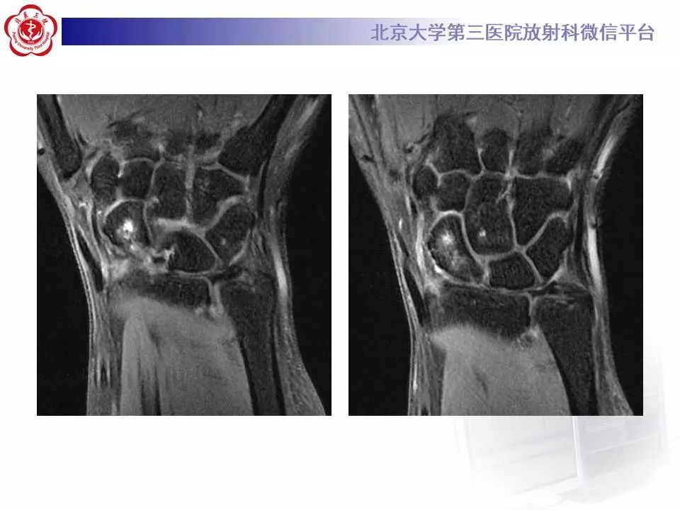 【病例】腕管综合征1例MR影像表现