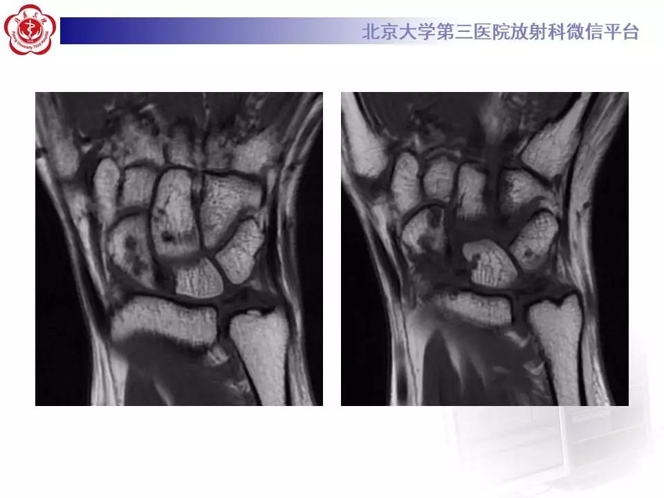 【病例】腕管综合征1例MR影像表现