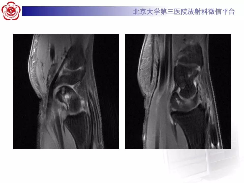 【病例】腕管综合征1例MR影像表现