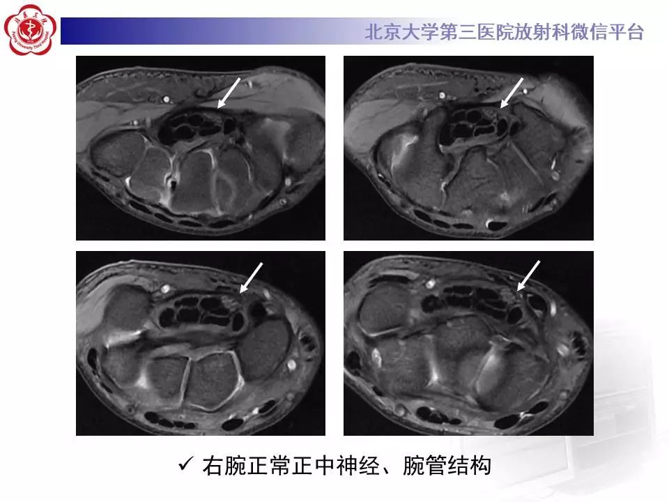 【病例】腕管综合征1例MR影像表现