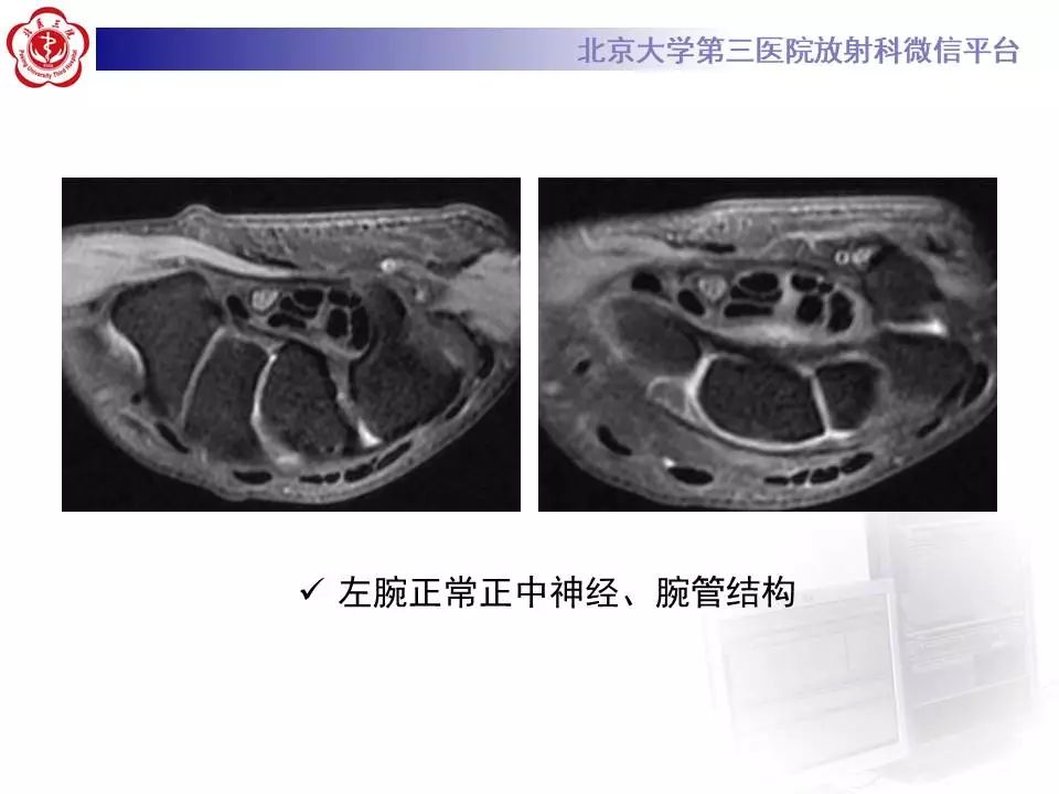 【病例】腕管综合征1例MR影像表现