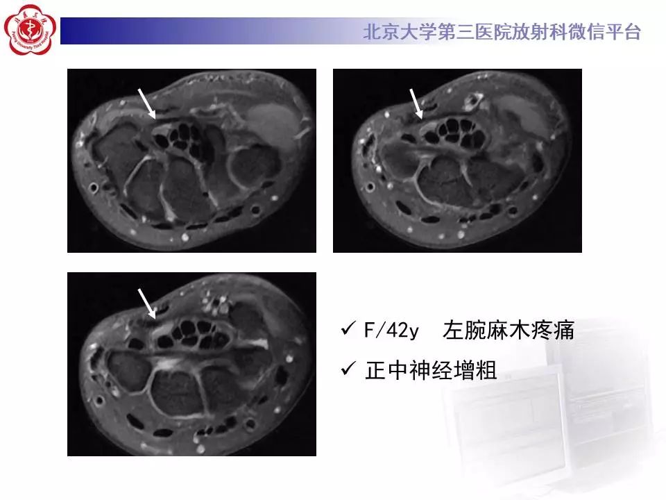 【病例】腕管综合征1例MR影像表现