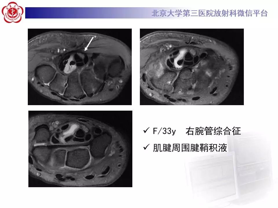 【病例】腕管综合征1例MR影像表现