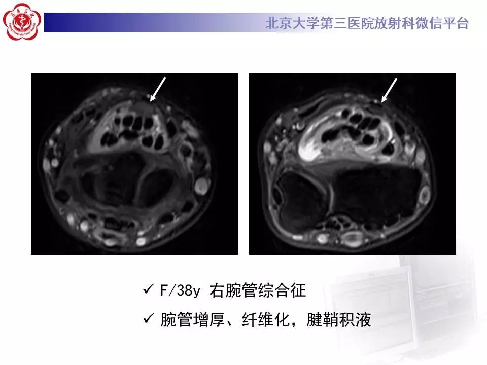 【病例】腕管综合征1例MR影像表现
