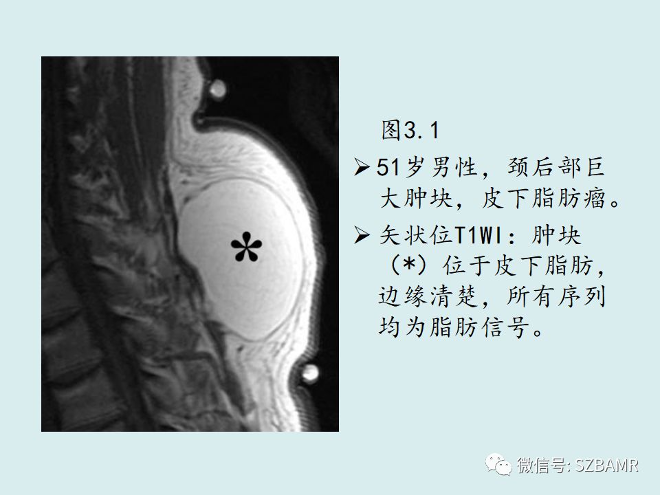 【PPT】浅表软组织肿块的影像分析、诊断及鉴别