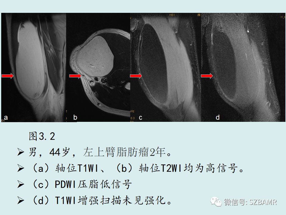 【PPT】浅表软组织肿块的影像分析、诊断及鉴别