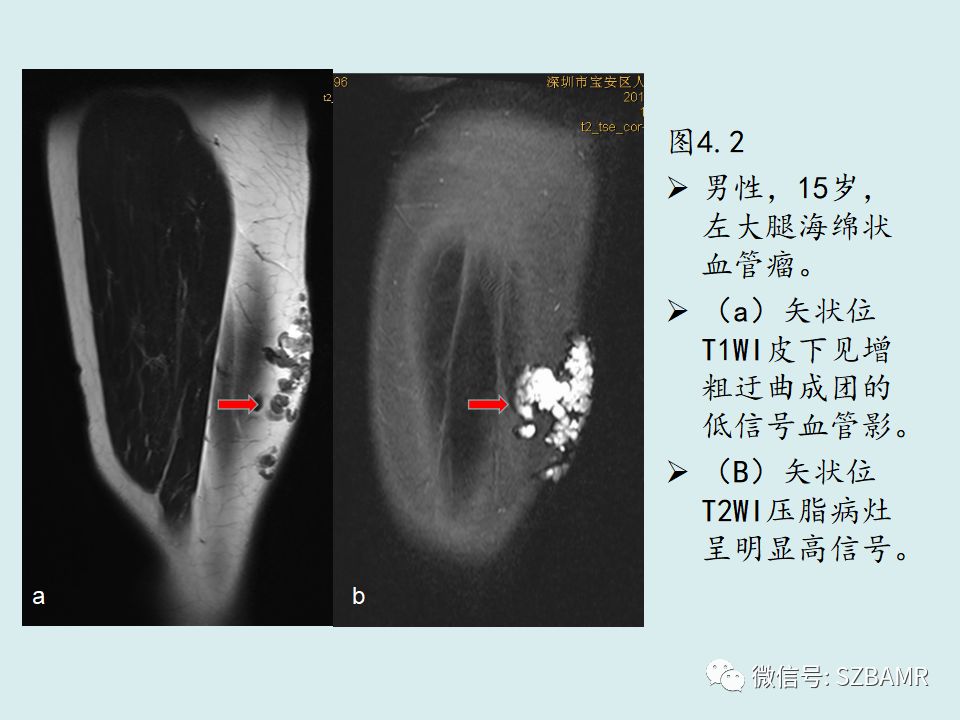 【PPT】浅表软组织肿块的影像分析、诊断及鉴别