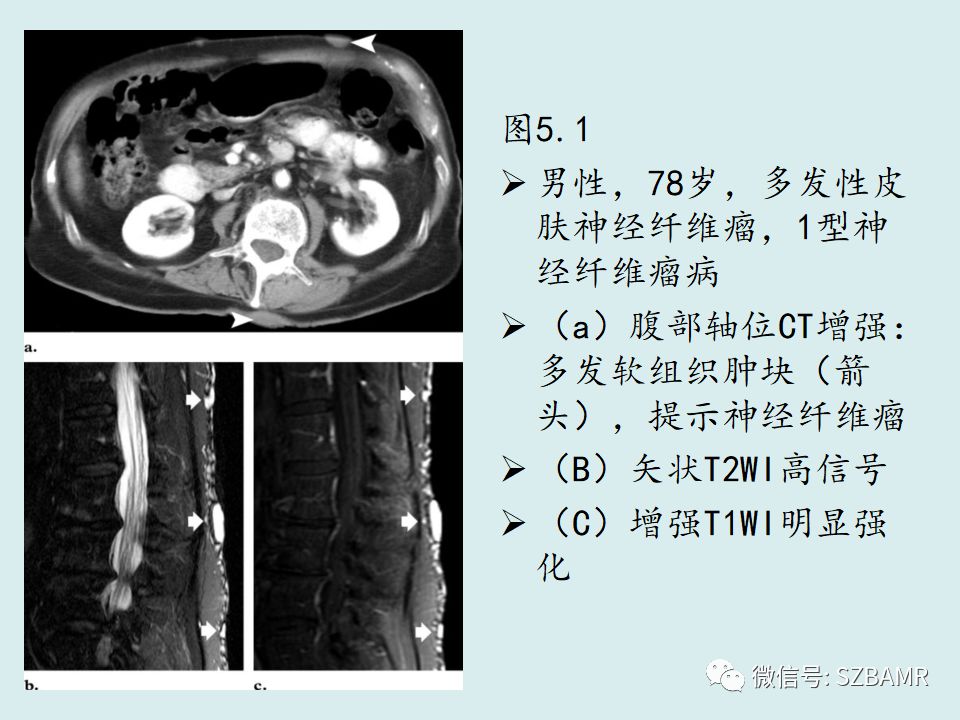 【PPT】浅表软组织肿块的影像分析、诊断及鉴别