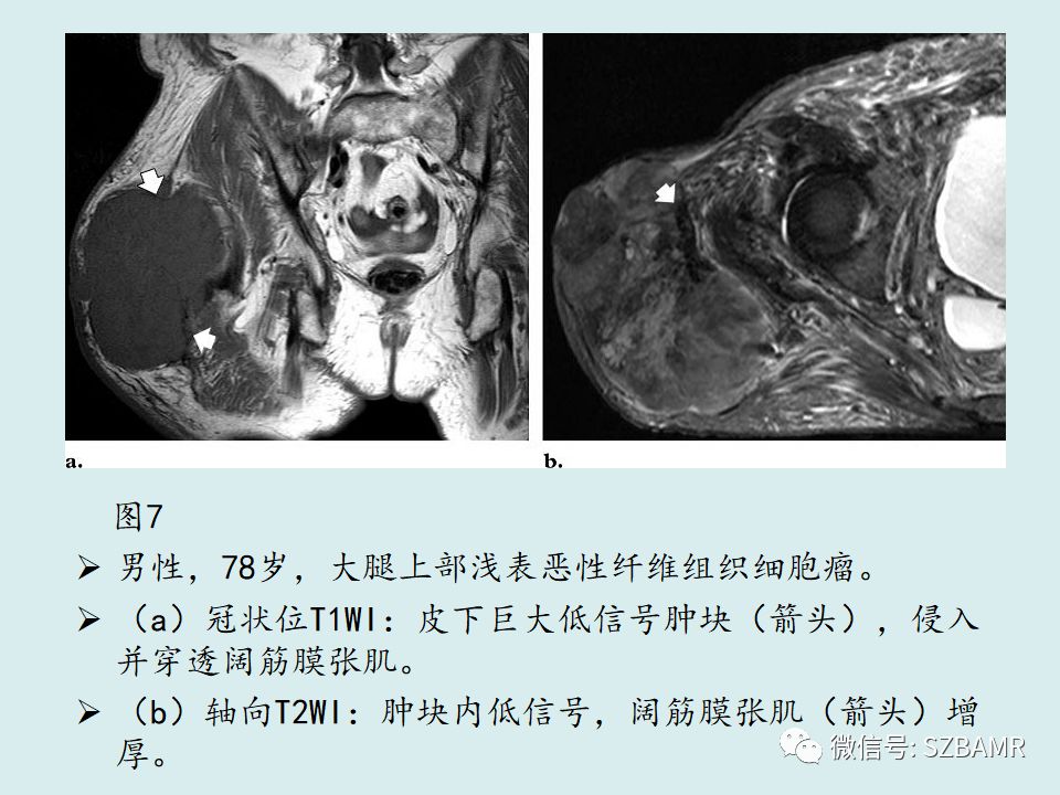 【PPT】浅表软组织肿块的影像分析、诊断及鉴别