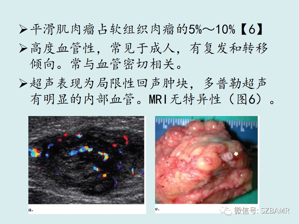 【PPT】浅表软组织肿块的影像分析、诊断及鉴别