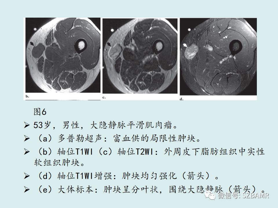 【PPT】浅表软组织肿块的影像分析、诊断及鉴别