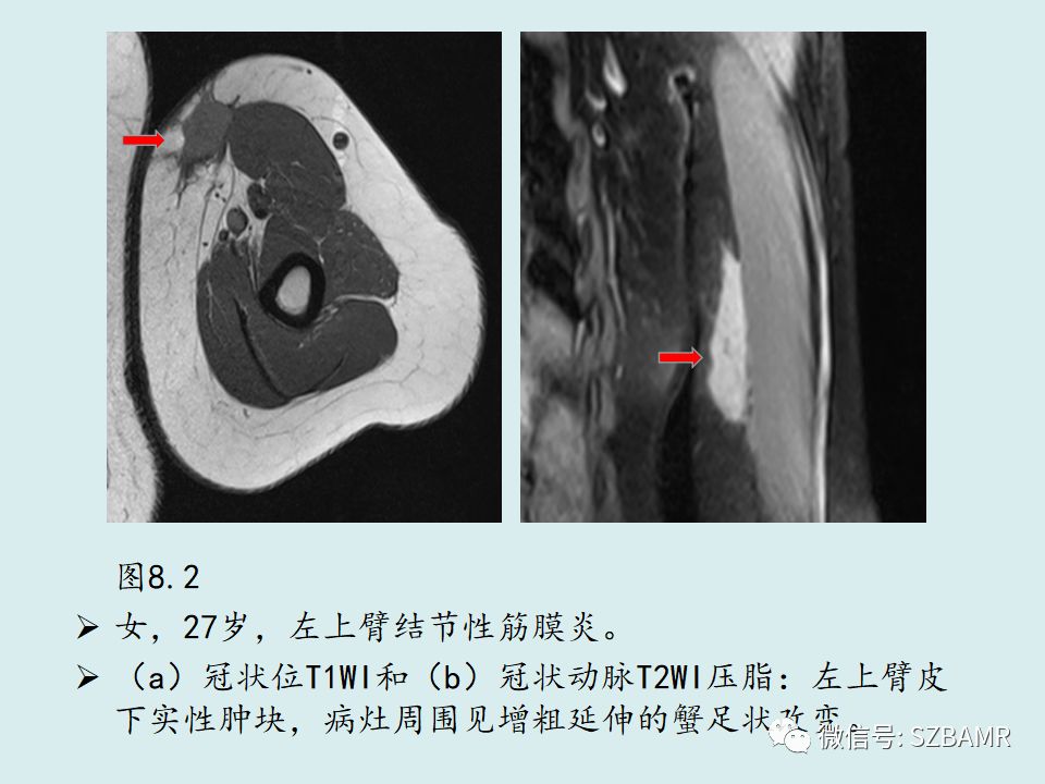 【PPT】浅表软组织肿块的影像分析、诊断及鉴别