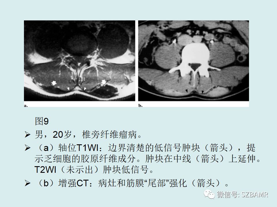 【PPT】浅表软组织肿块的影像分析、诊断及鉴别