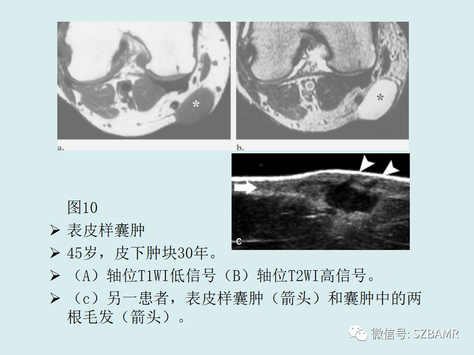 【PPT】浅表软组织肿块的影像分析、诊断及鉴别