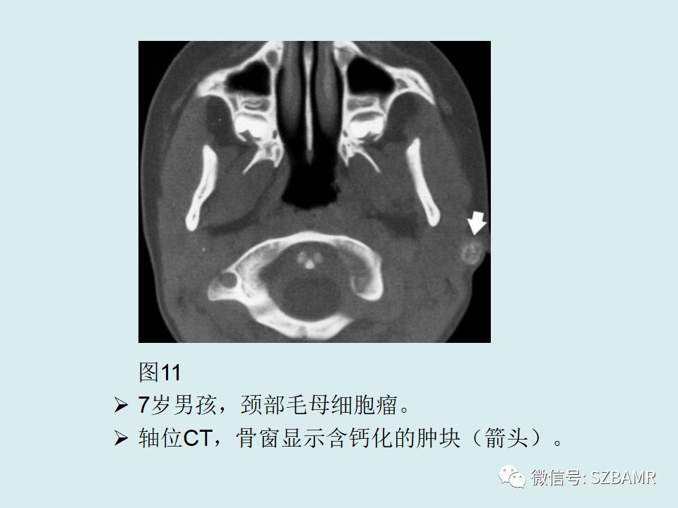 【PPT】浅表软组织肿块的影像分析、诊断及鉴别