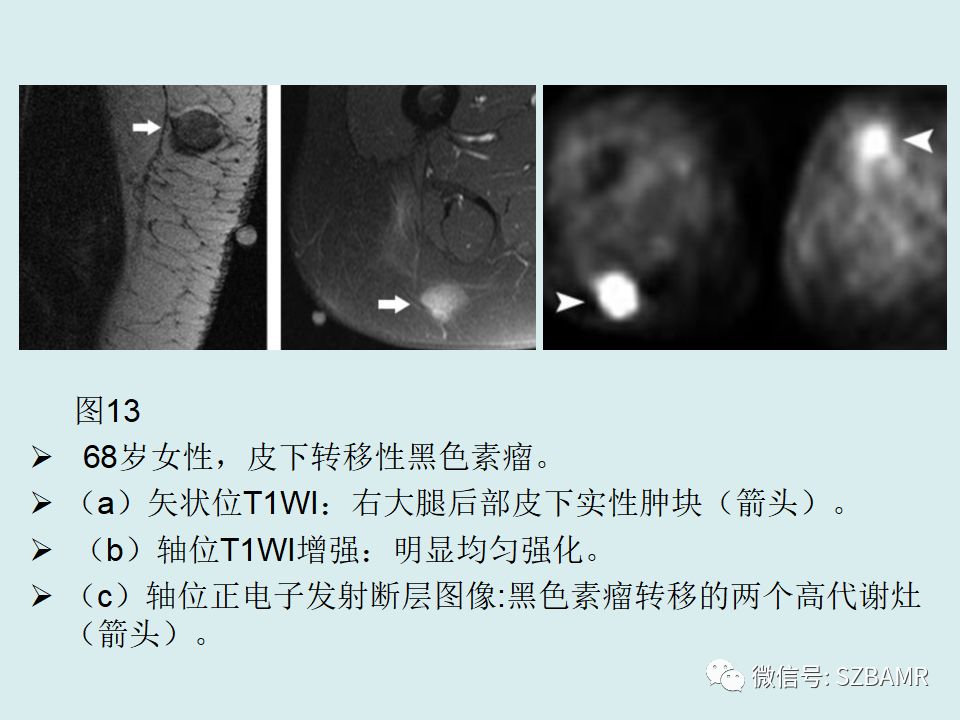 【PPT】浅表软组织肿块的影像分析、诊断及鉴别