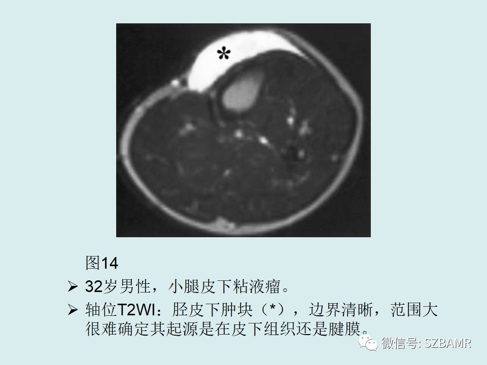 【PPT】浅表软组织肿块的影像分析、诊断及鉴别