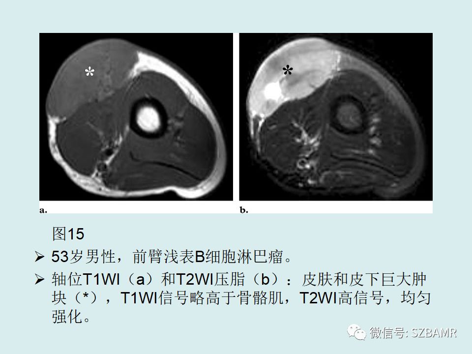 【PPT】浅表软组织肿块的影像分析、诊断及鉴别
