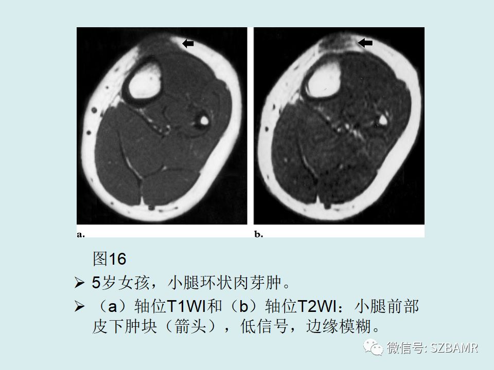 【PPT】浅表软组织肿块的影像分析、诊断及鉴别