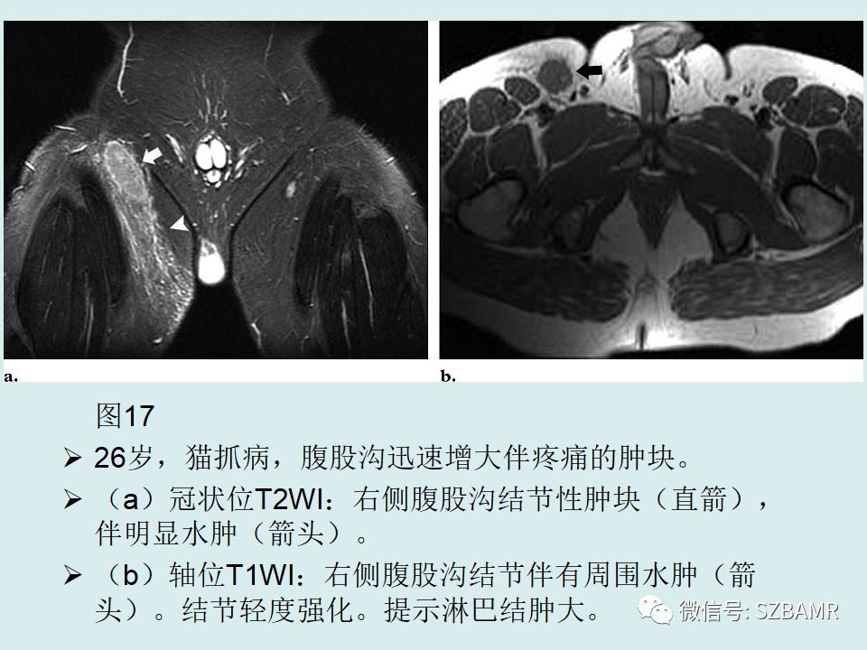 【PPT】浅表软组织肿块的影像分析、诊断及鉴别