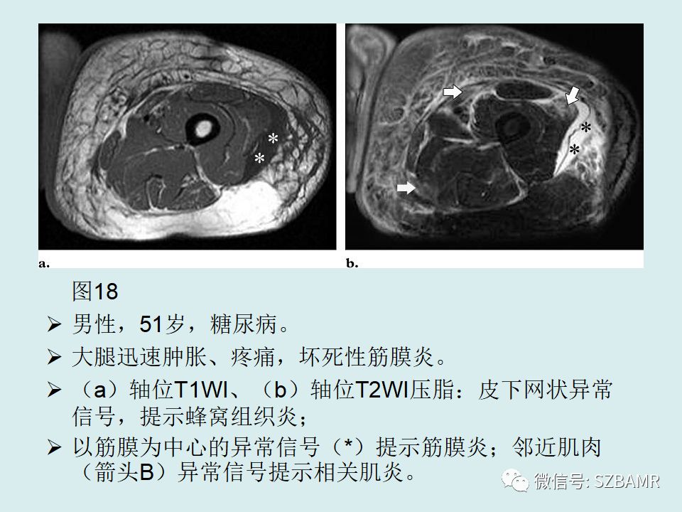【PPT】浅表软组织肿块的影像分析、诊断及鉴别