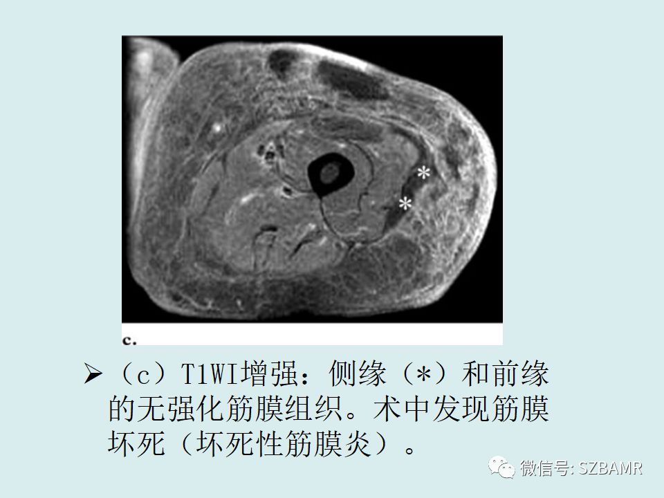 【PPT】浅表软组织肿块的影像分析、诊断及鉴别