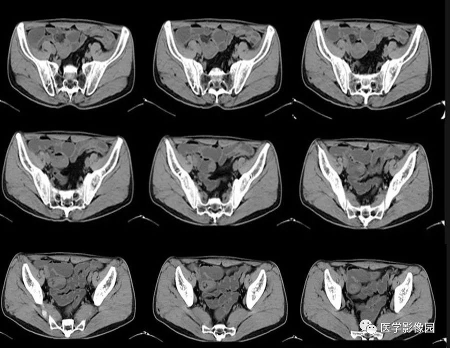 【病例】回肠远端迷走胰腺1例CT影像表现 【病例】回肠远端迷走胰腺1例CT影像表现