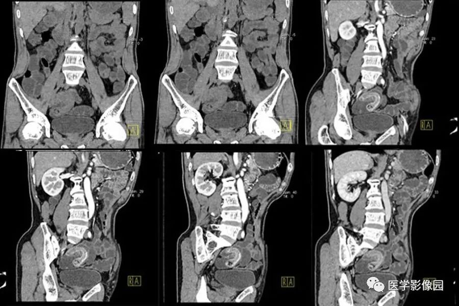 【病例】回肠远端迷走胰腺1例CT影像表现 【病例】回肠远端迷走胰腺1例CT影像表现