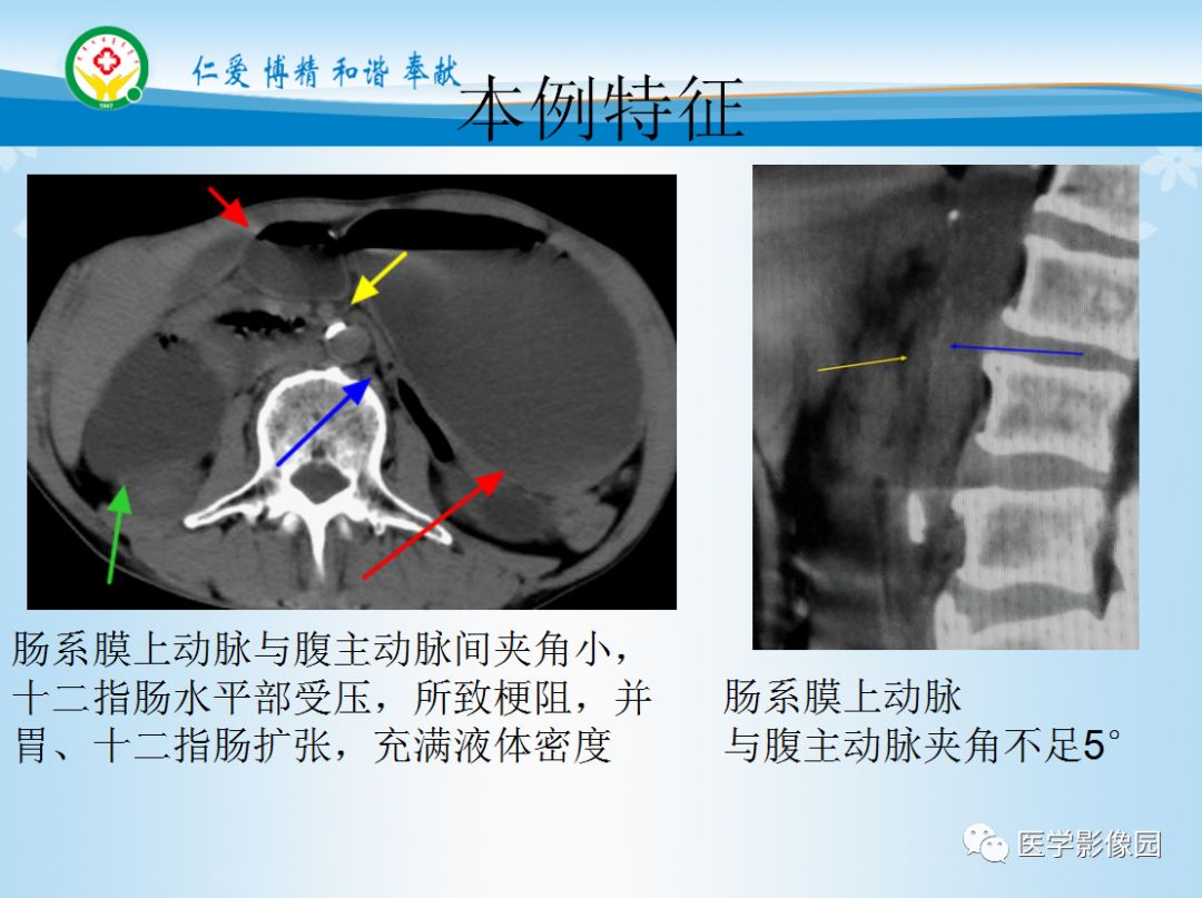 【病例】良性十二指肠瘀滞症1例CT影像分析
