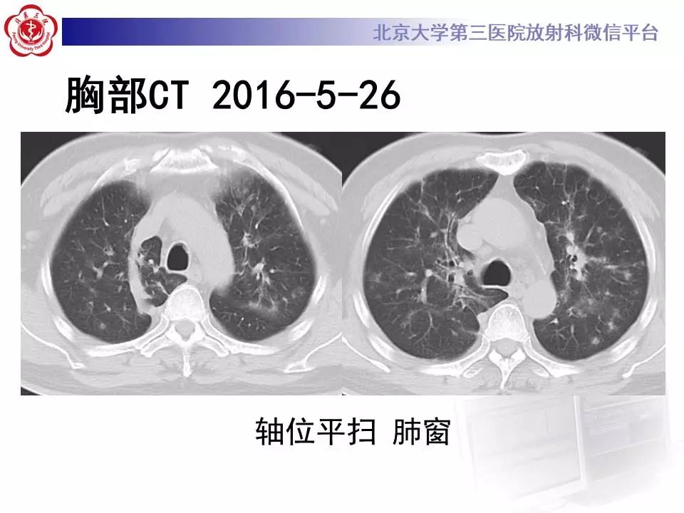 【病例】过敏性肺炎1例CT影像表现