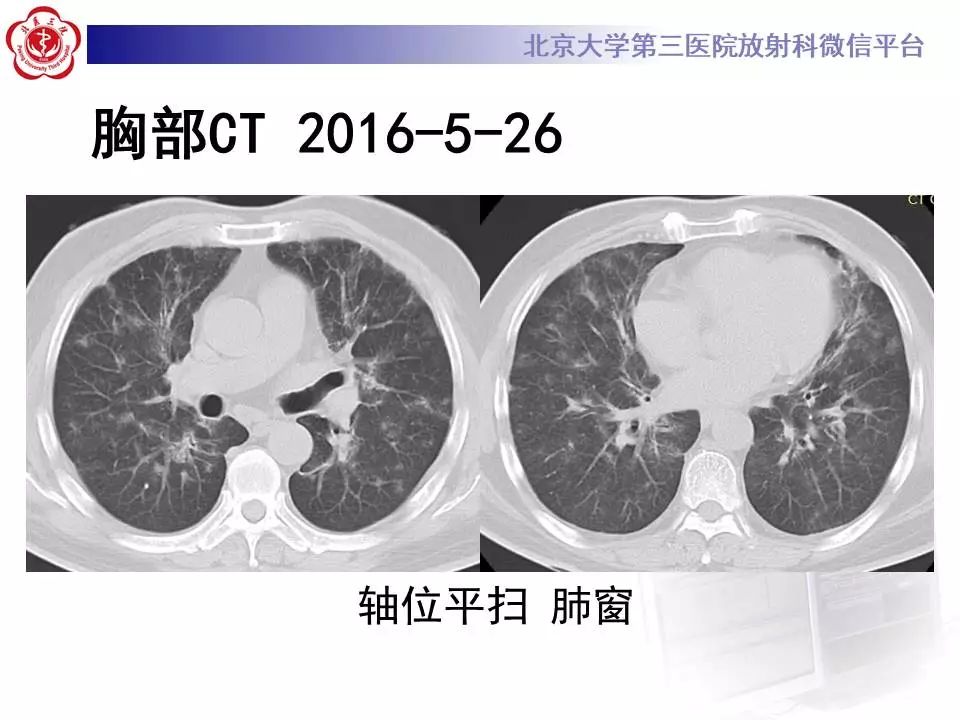 【病例】过敏性肺炎1例CT影像表现