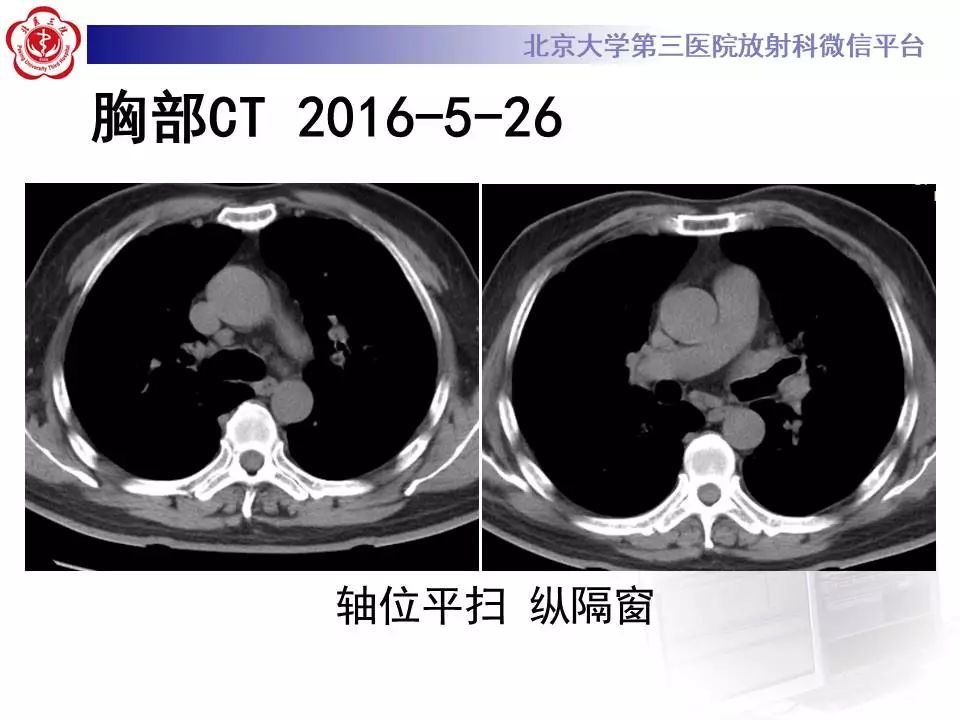 【病例】过敏性肺炎1例CT影像表现