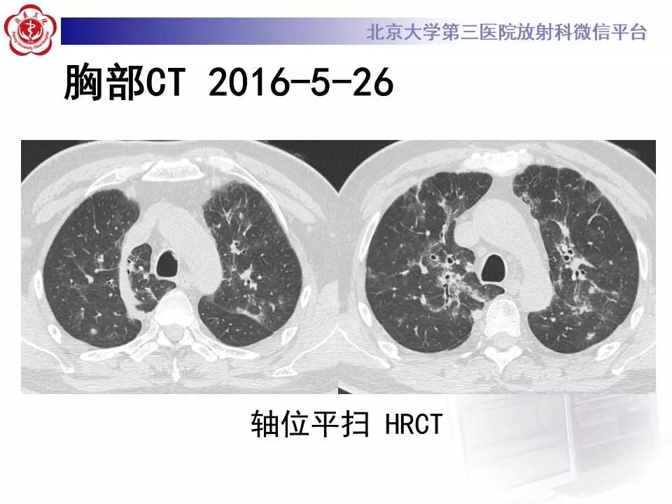 【病例】过敏性肺炎1例CT影像表现