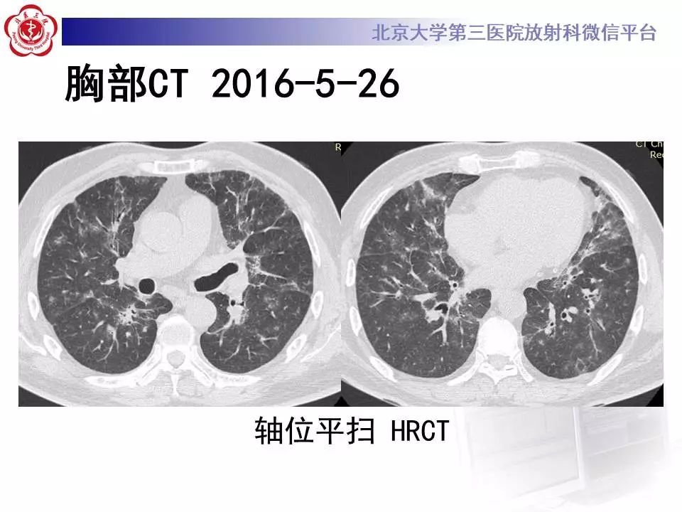 【病例】过敏性肺炎1例CT影像表现