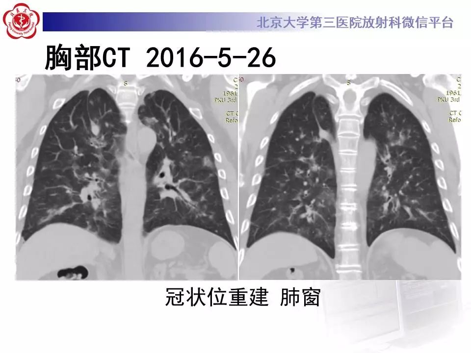 【病例】过敏性肺炎1例CT影像表现