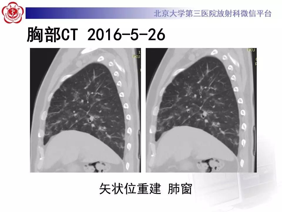 【病例】过敏性肺炎1例CT影像表现