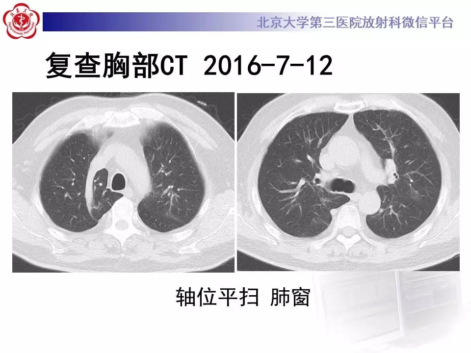 【病例】过敏性肺炎1例CT影像表现