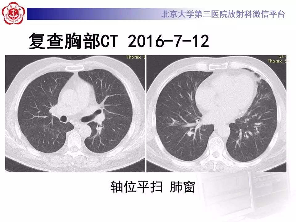 【病例】过敏性肺炎1例CT影像表现