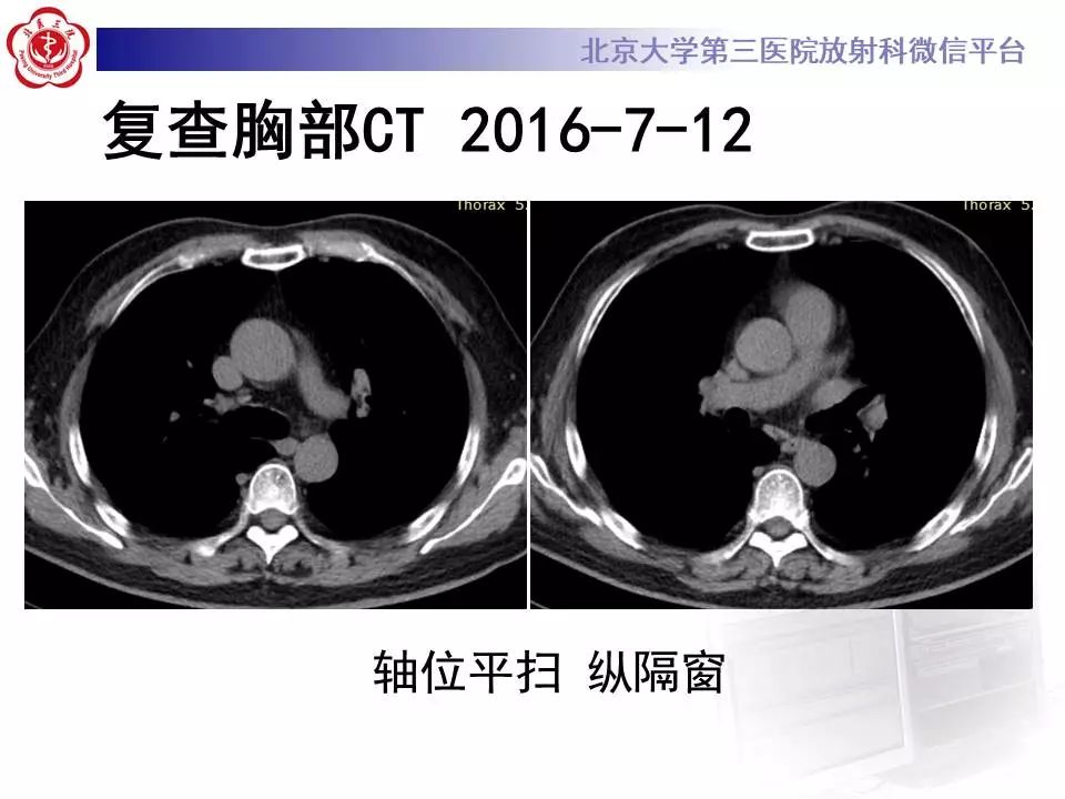 【病例】过敏性肺炎1例CT影像表现