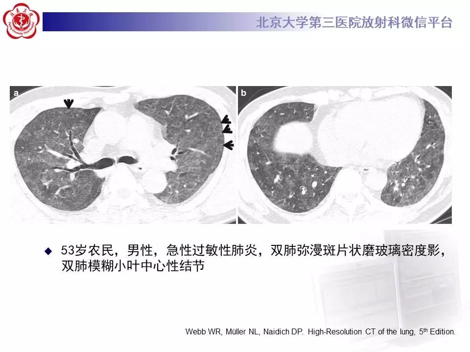 【病例】过敏性肺炎1例CT影像表现