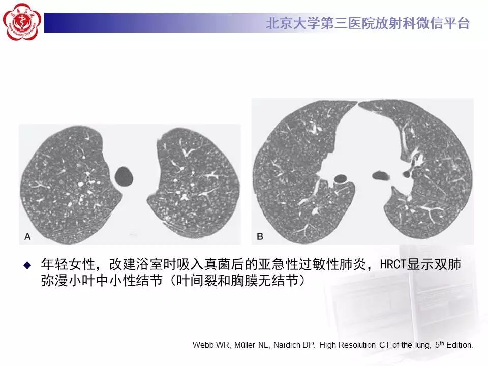 【病例】过敏性肺炎1例CT影像表现