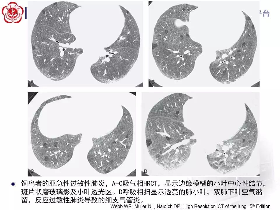 【病例】过敏性肺炎1例CT影像表现