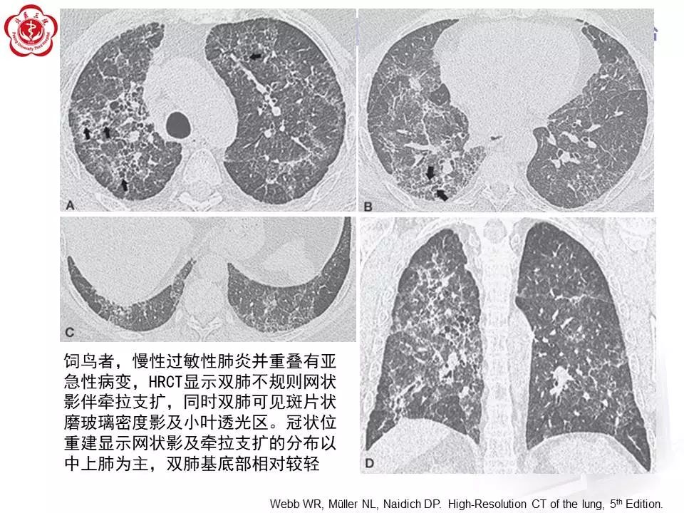 【病例】过敏性肺炎1例CT影像表现