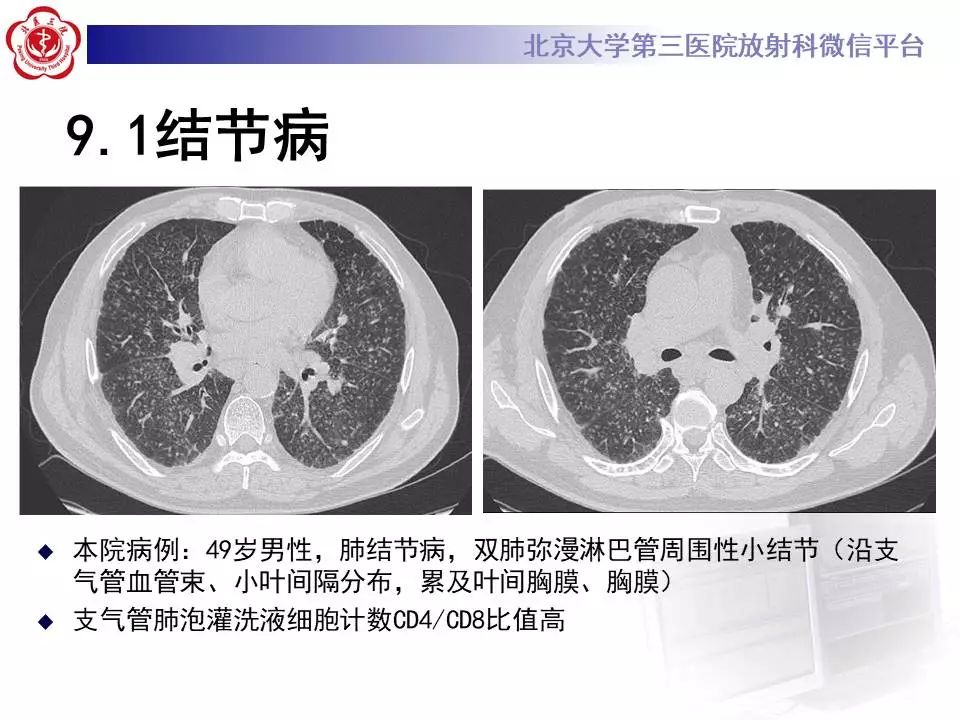 【病例】过敏性肺炎1例CT影像表现