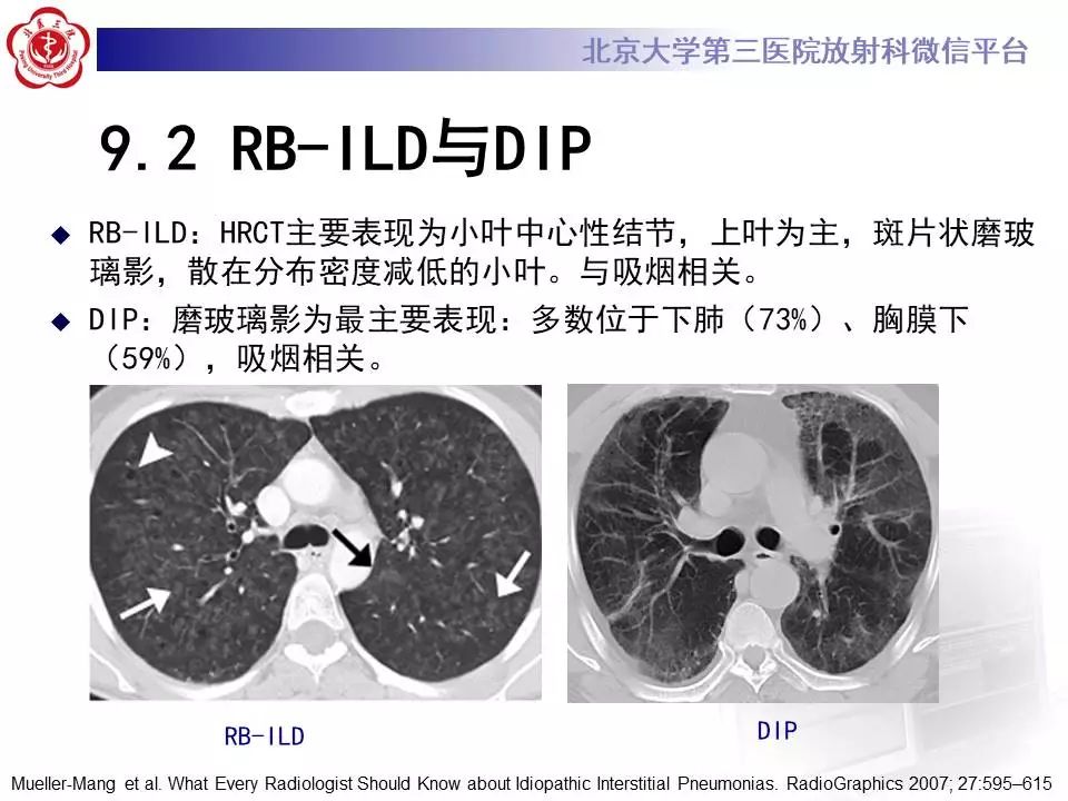 【病例】过敏性肺炎1例CT影像表现
