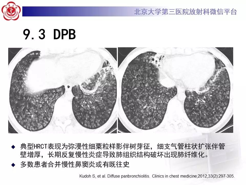 【病例】过敏性肺炎1例CT影像表现