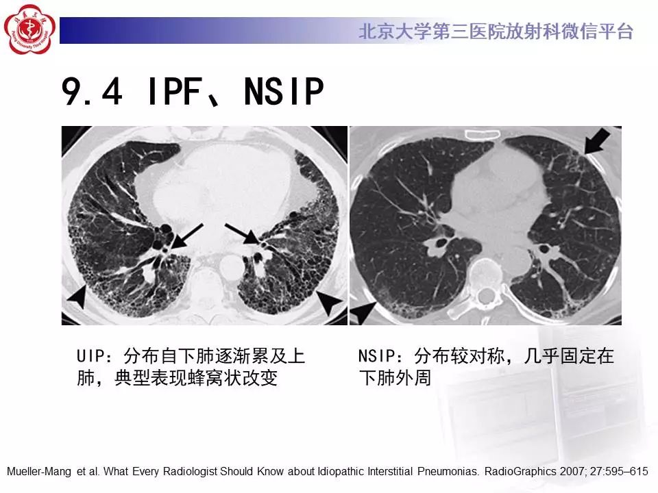 【病例】过敏性肺炎1例CT影像表现