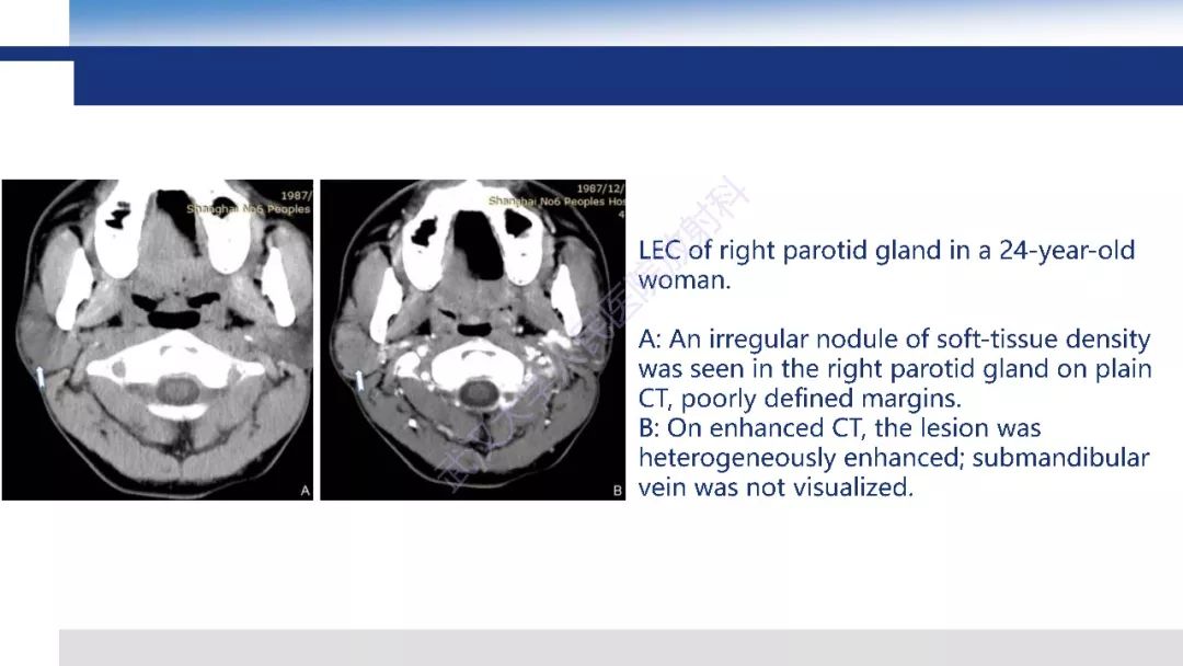 【PPT】涎腺淋巴上皮癌影像诊断