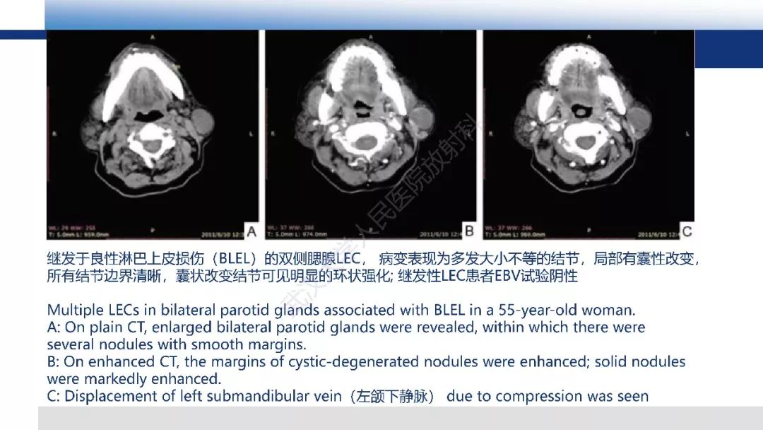 【PPT】涎腺淋巴上皮癌影像诊断