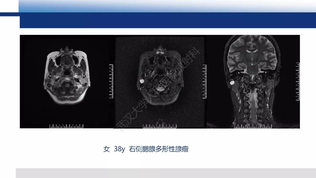 【PPT】涎腺淋巴上皮癌影像诊断